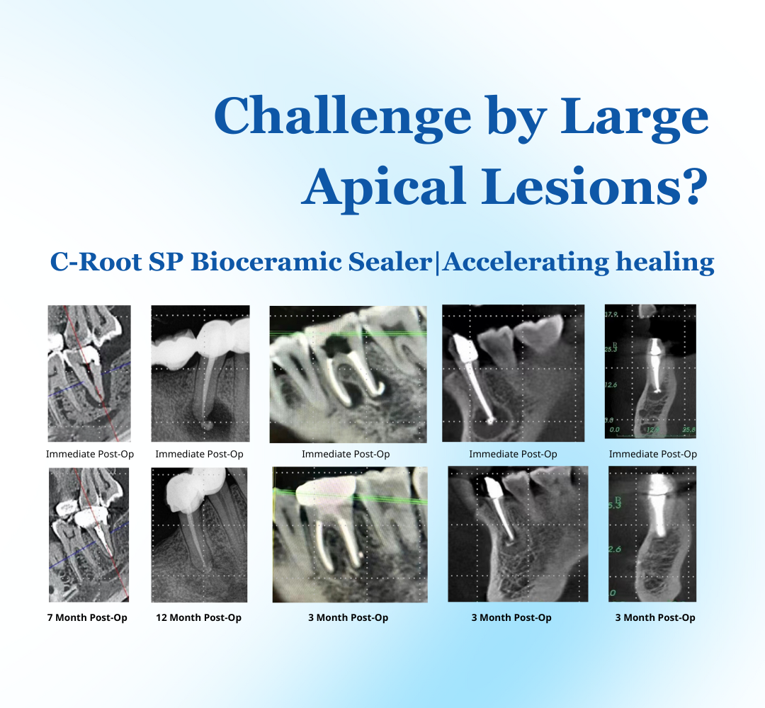 C-Root SP | Bioceramic Root Canal Sealer