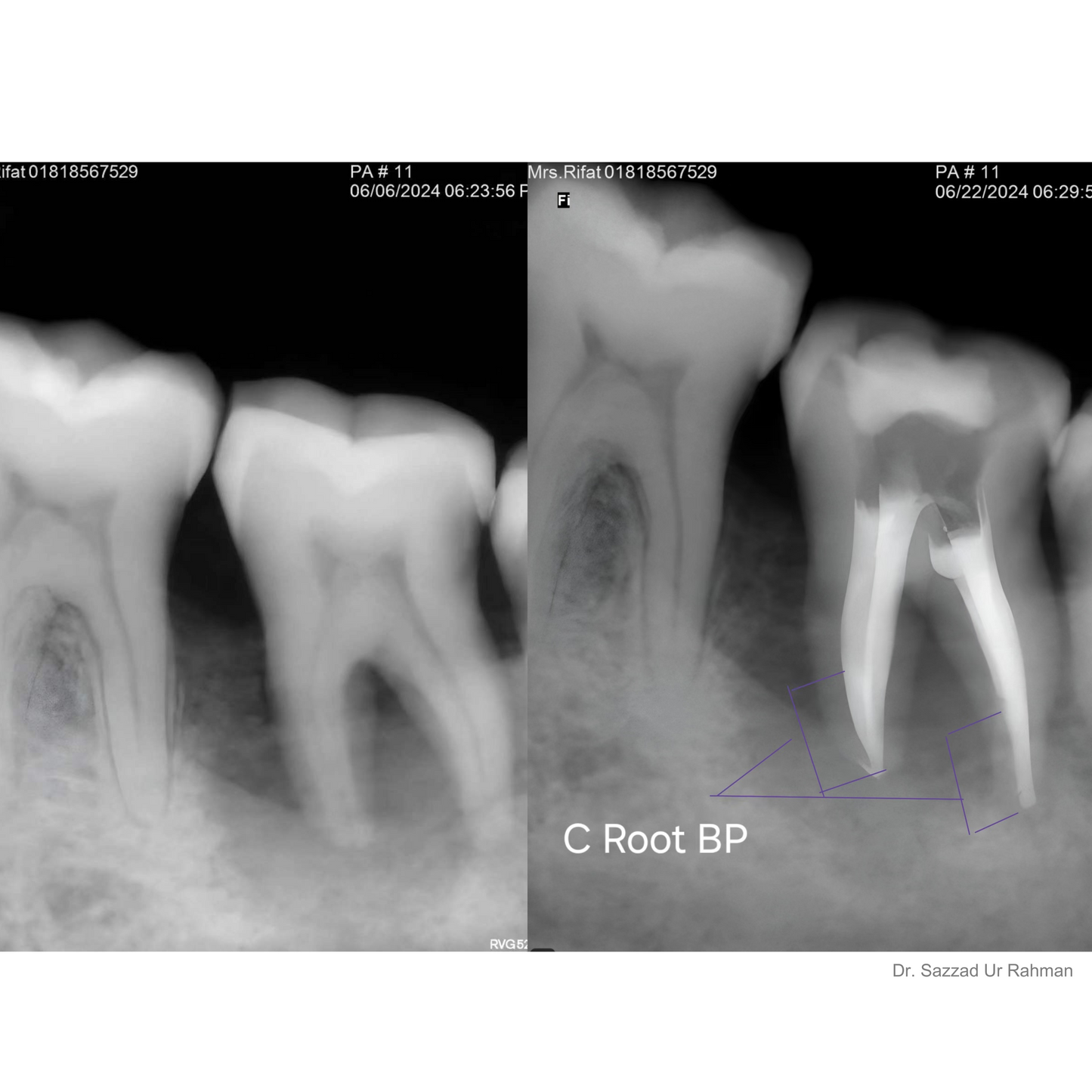 C-Root BP | Strontium-Based Bioceramic Root Repair Material