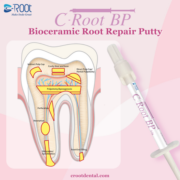 C-Root BP | Bioceramic Root Repair Material/Putty – C-Root Dental Medical