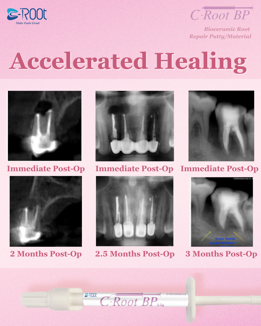 C-Root BP |  Bioceramic Root Repair Material/Putty